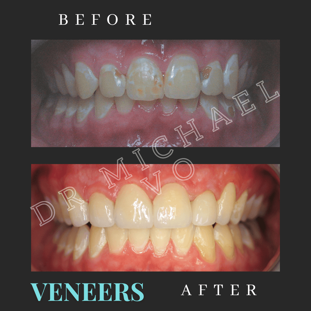 Veneers - West Island Dental Clinic