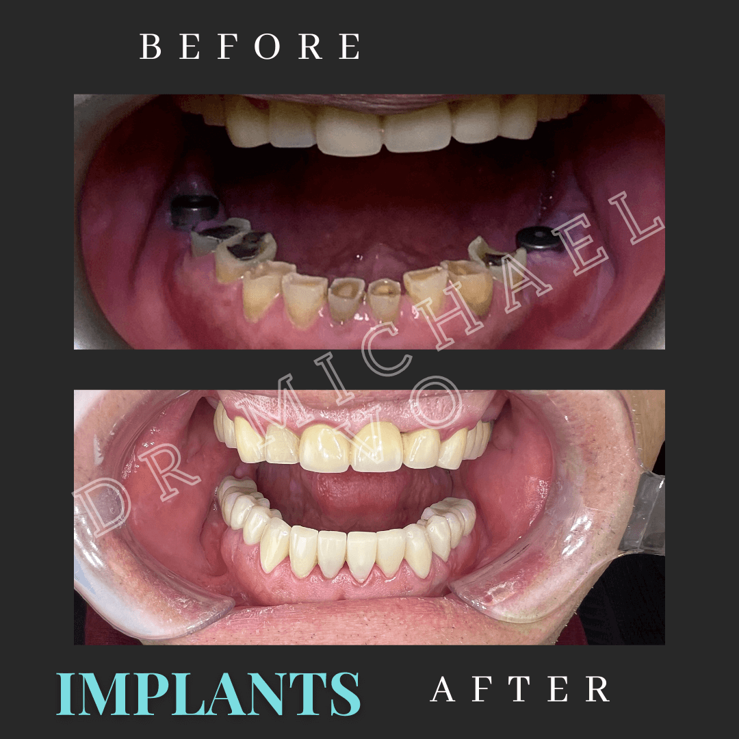 Dental Implants West Island Dental Clinic