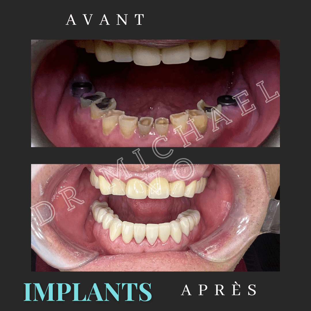Implants - West Island Dental Clinic