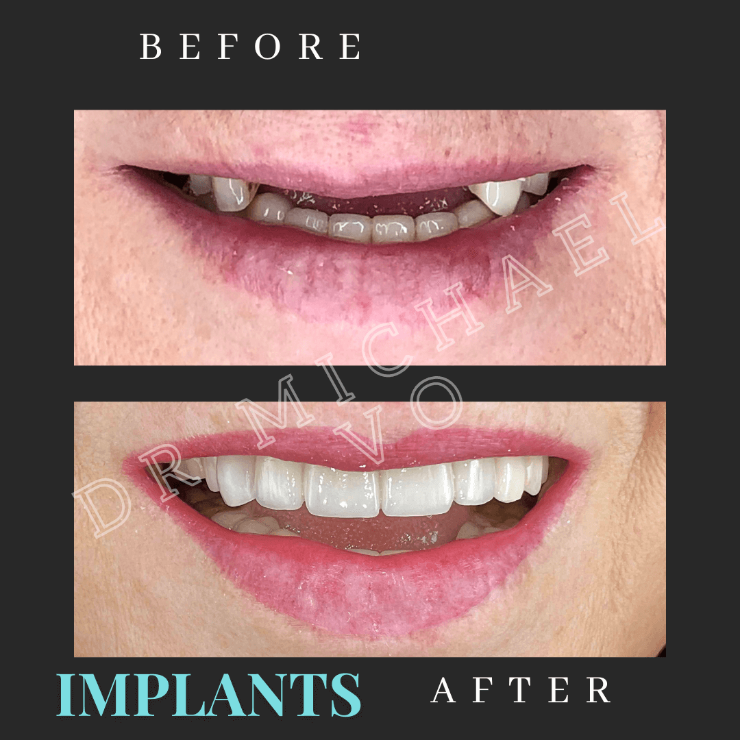 Dental Implants West Island Dental Clinic