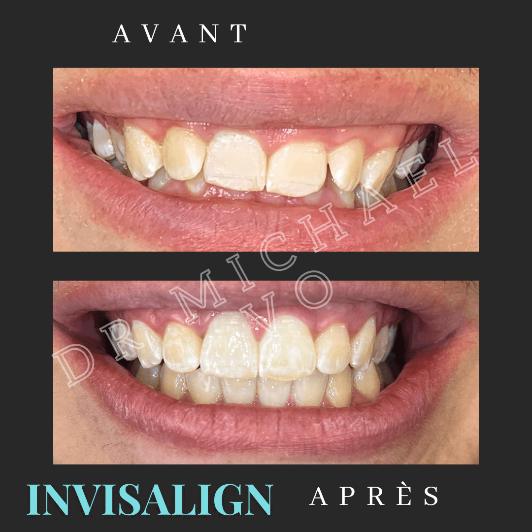 Invisalign Treatment - West Island Dental Clinic